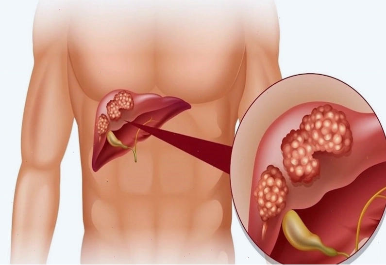 Ngứa khắp người có thể là do bệnh lý về gan gây ra.