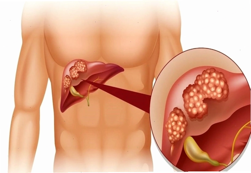 Ngứa khắp người có thể là do bệnh lý về gan gây ra