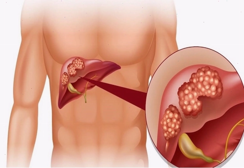 Ngứa khắp người có thể là do bệnh lý về gan gây ra