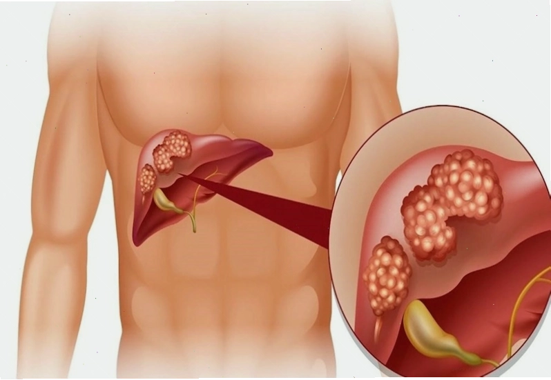 Ngứa khắp người có thể là do bệnh lý về gan gây ra