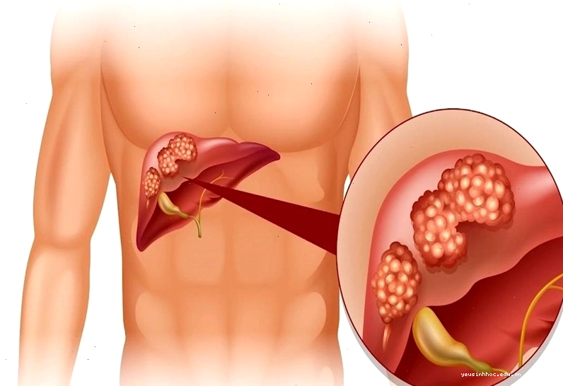Ngứa khắp người có thể là triệu chứng của các bệnh lý về gan