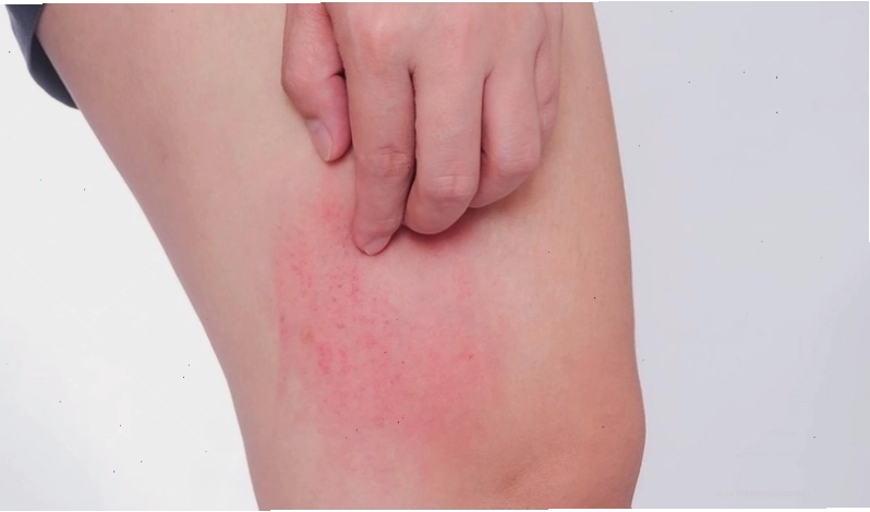 Ngứa khắp người không rõ nguyên nhân có thể là triệu chứng đầu tiên của các loại dị ứng