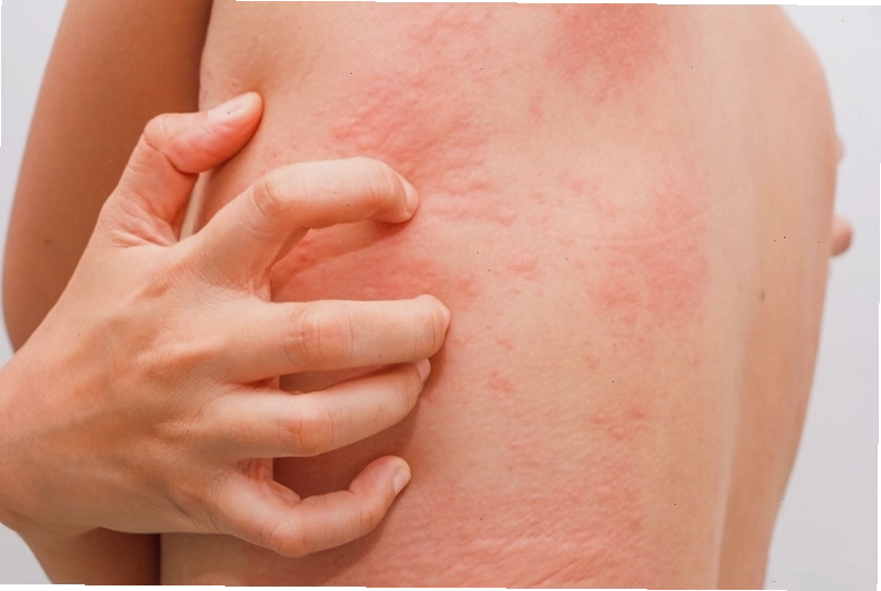 Người bị ngứa gãi nổi cục có nguy hiểm không? Cần làm gì khi da bị ngứa gãi nổi cục? 1