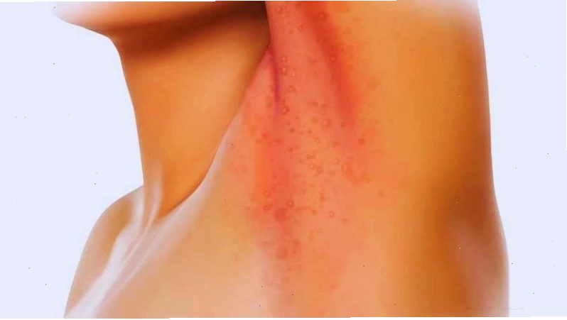 Người lớn bị hăm da ở vùng cổ và nách do tiết mồ hôi nhiều
