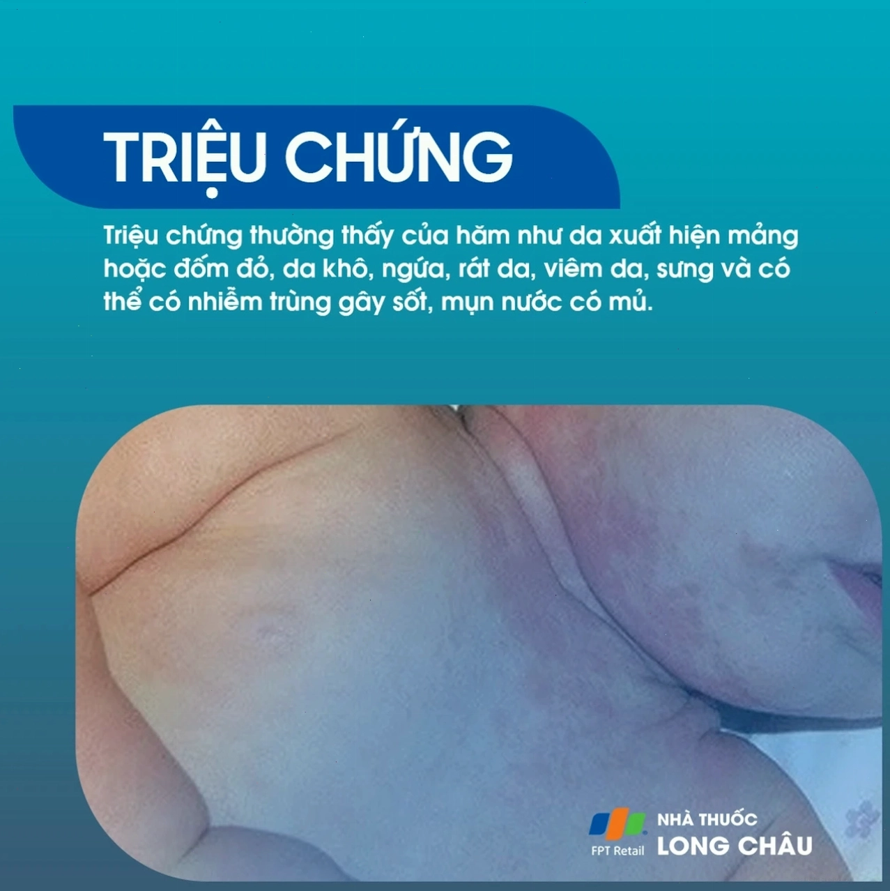 Người lớn bị hăm nách với các triệu chứng đỏ rát