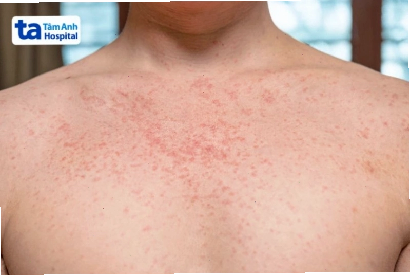 Người lớn bị sốt phát ban có thể gây nguy hiểm nếu không được chăm sóc đúng cách