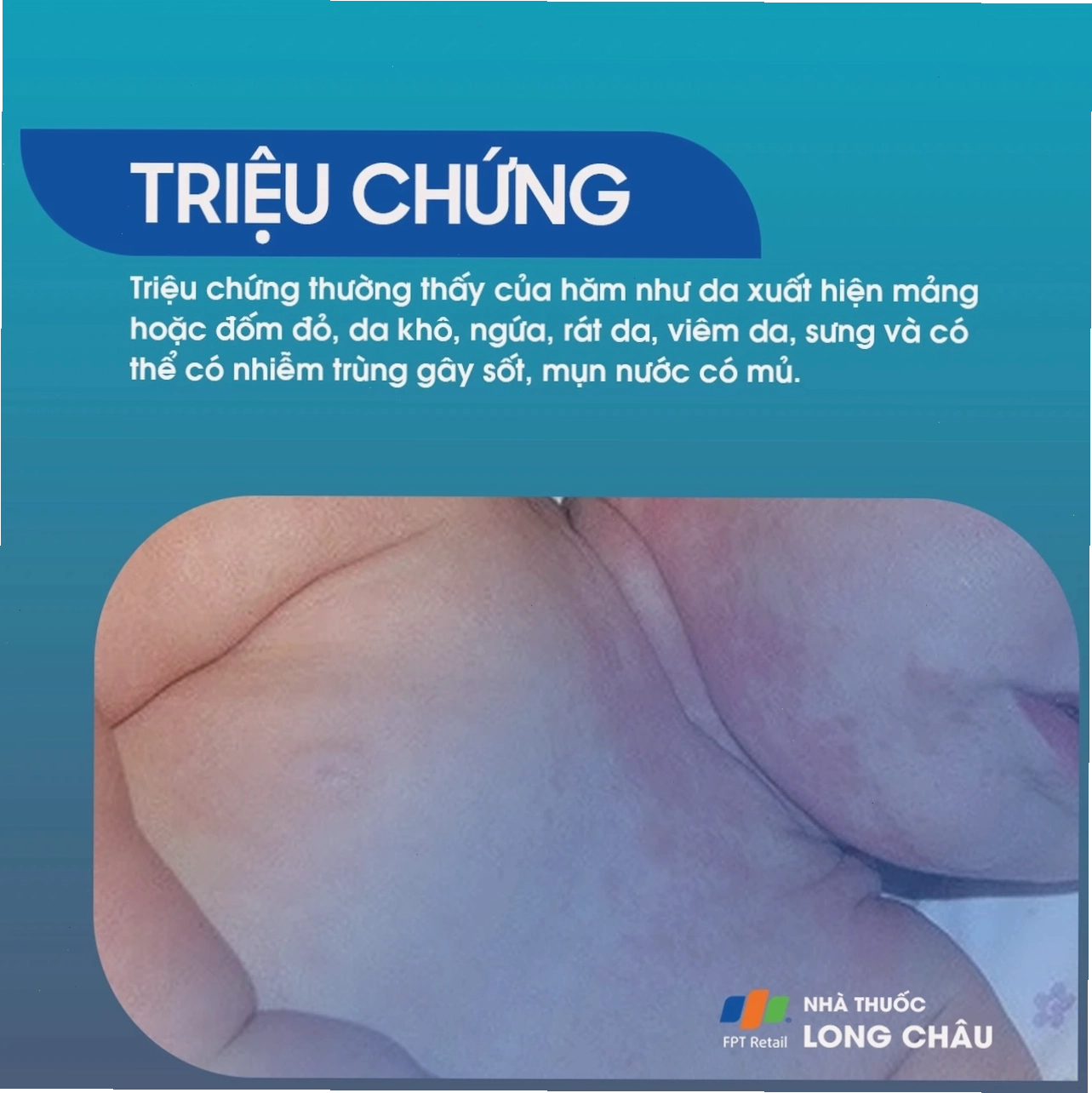Người lớn cần lựa chọn trang phục thoáng khí để phòng ngừa hăm mông