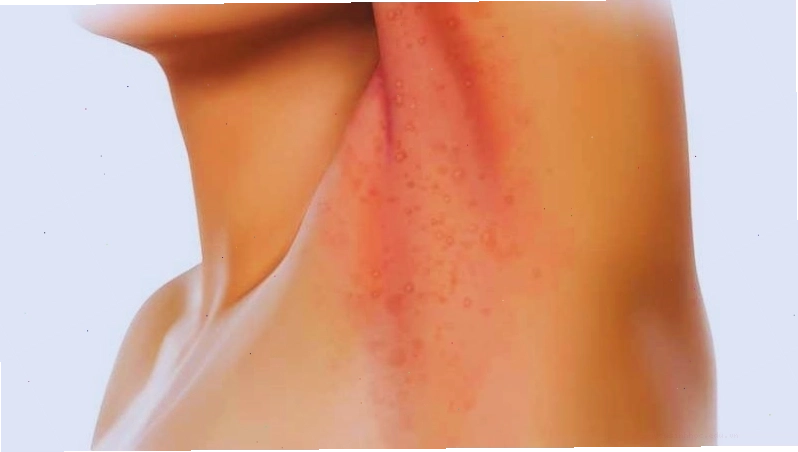 Người lớn thường bị hăm da ở vùng tiết mồ hôi nhiều như cổ, nách, kẽ ngón chân, vùng mông và bẹn