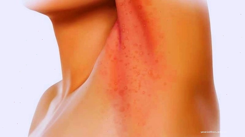Người lớn thường bị hăm da ở vùng tiết mồ hôi nhiều như cổ, nách, kẽ ngón chân