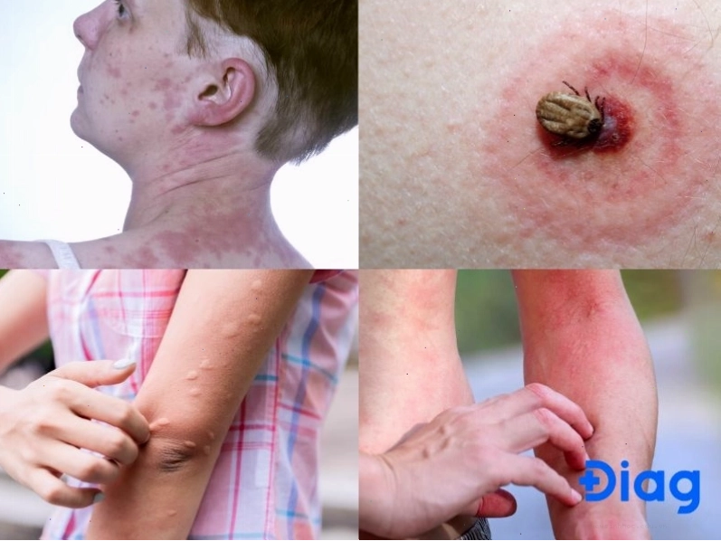 Nguyên nhân gây nổi mẩn đỏ ngứa như muỗi đốt