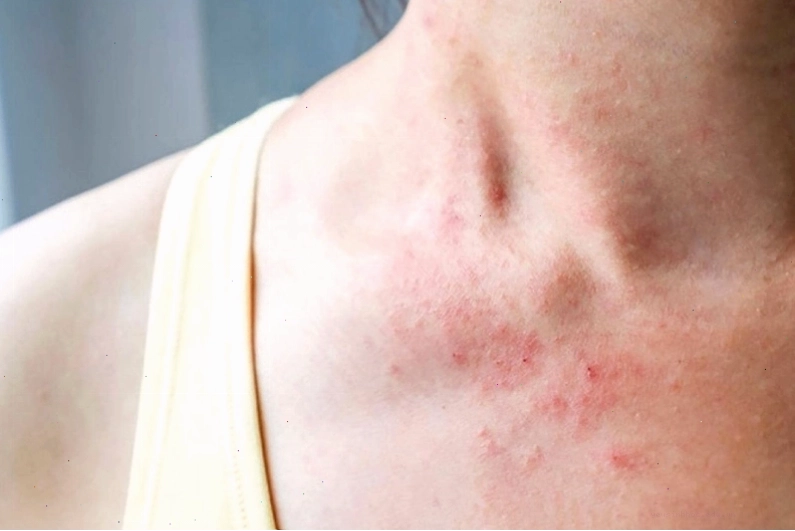 Nguyên nhân gây nổi mẩn đỏ ở cổ do dị ứng mỹ phẩm hoặc trang sức