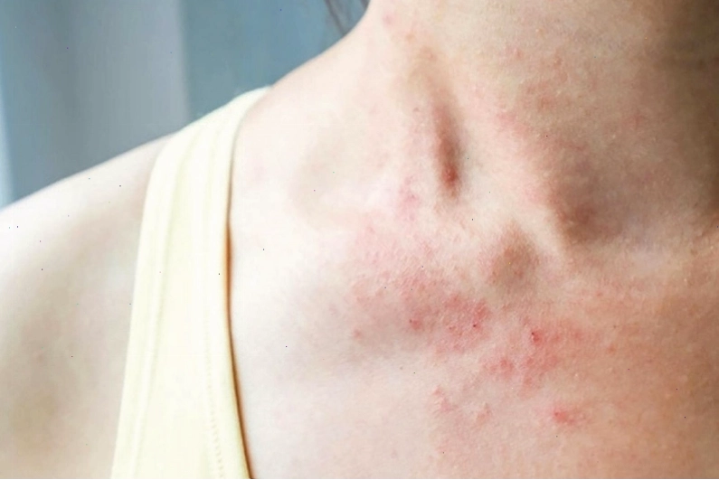 Nguyên nhân gây nổi mẩn đỏ ở cổ người lớn