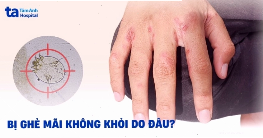 Nguyên nhân khiến bệnh ghẻ mãi không khỏi