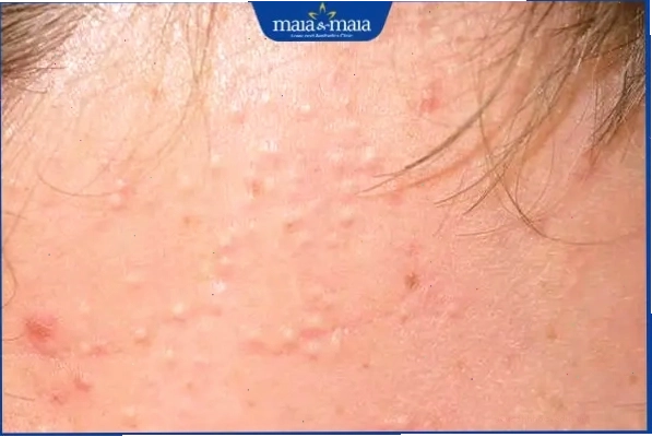 Nhận biết mụn hạt kê với các nốt nhỏ li ti trên da