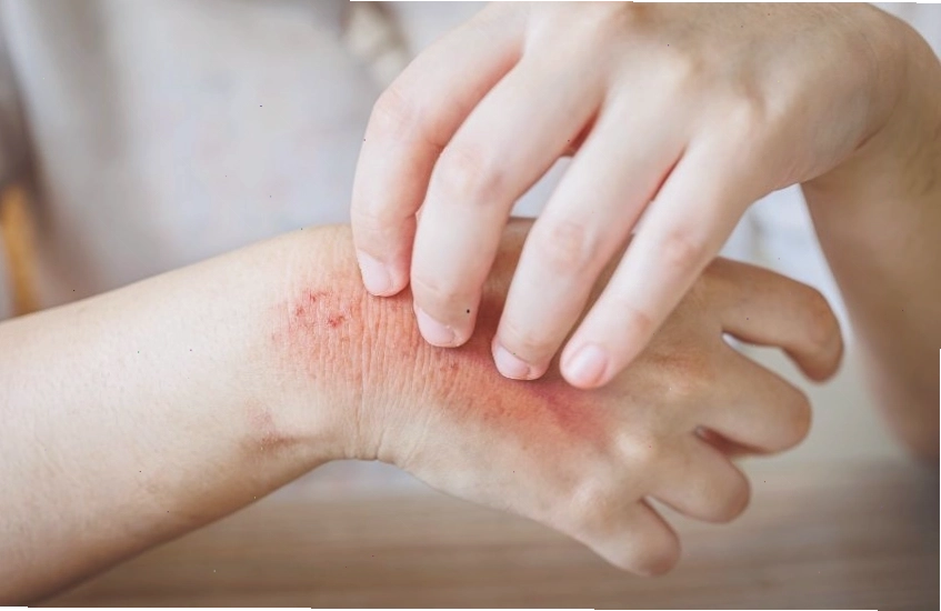 Nhận biết sớm dấu hiệu nấm mèo ở người để có cách xử lý kịp thời