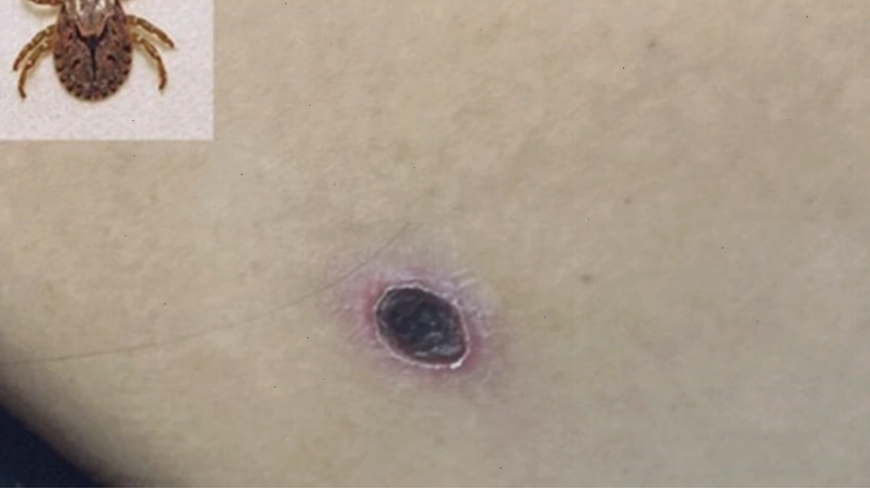 Nhiều loại virus có thể gây sốt phát ban ở người lớn