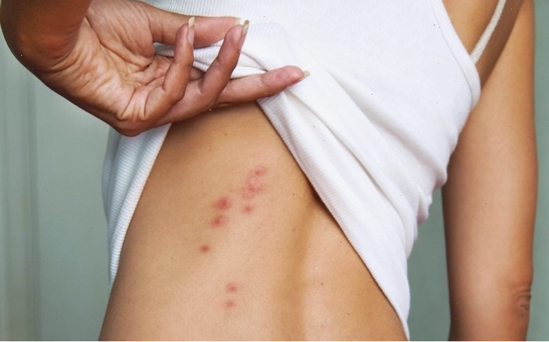 Nổi ban đỏ ngứa ở tay do tiếp xúc với hóa chất