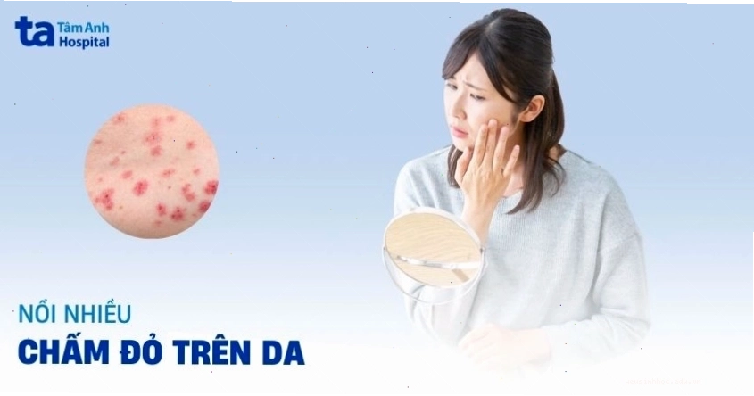 Nổi chấm đỏ trên da cần được chẩn đoán và điều trị sớm