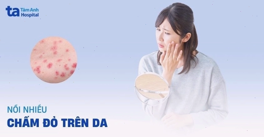 Nổi chấm đỏ trên da không ngứa có thể là dấu hiệu của ban xuất huyết