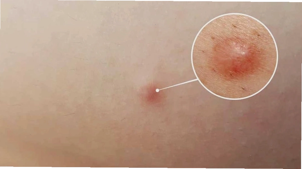 Nổi cục cứng dưới da có khả năng do nhiều loại khối u, cần thăm khám bác sĩ