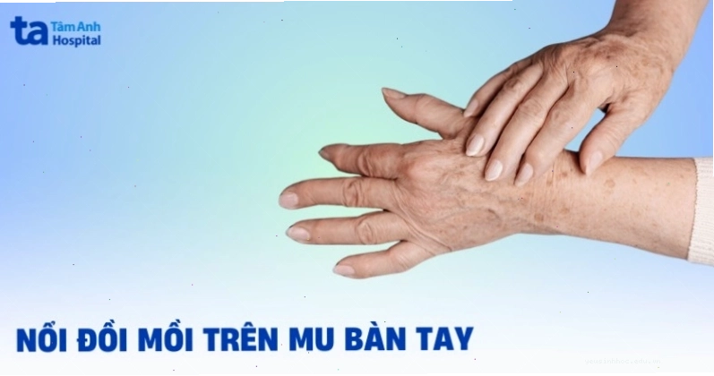 Nổi đồi mồi trên mu bàn tay cần được chẩn đoán chính xác