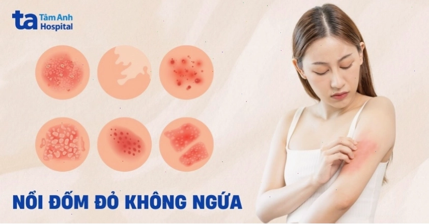 Nổi đốm đỏ trên da không ngứa có thể do nhiều nguyên nhân
