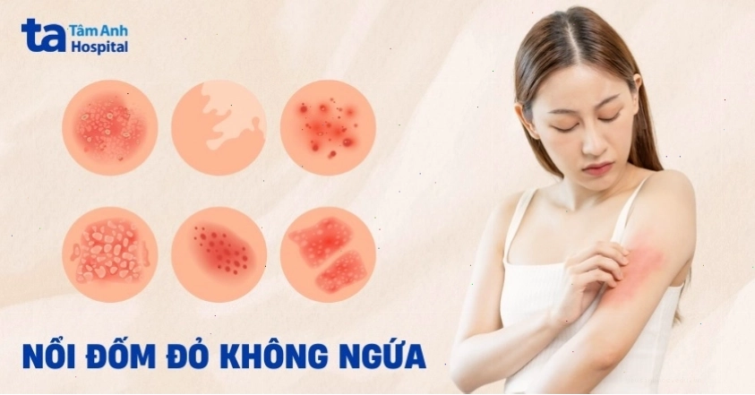 Nổi đốm đỏ trên da không ngứa có thể liên quan đến các bệnh lý khác