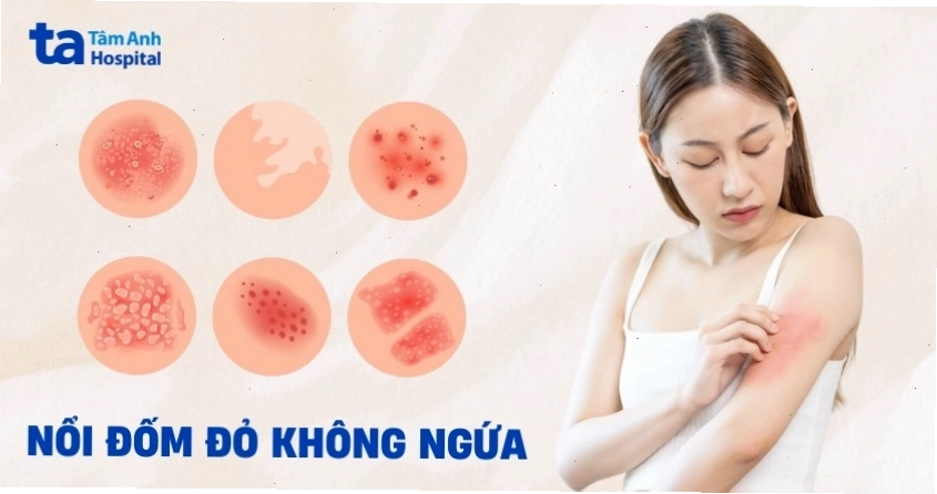 Nổi đốm đỏ trên da không ngứa cũng cần được chẩn đoán
