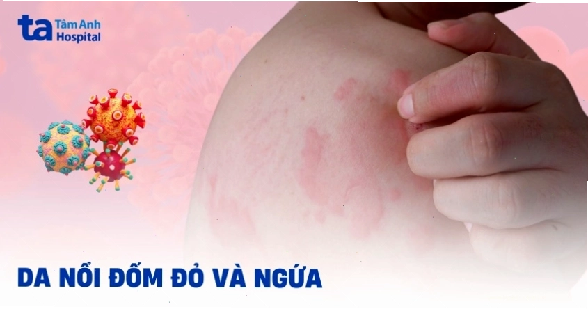 Nổi đốm đỏ trên da và ngứa: Khi nào cần tìm kiếm sự trợ giúp y tế