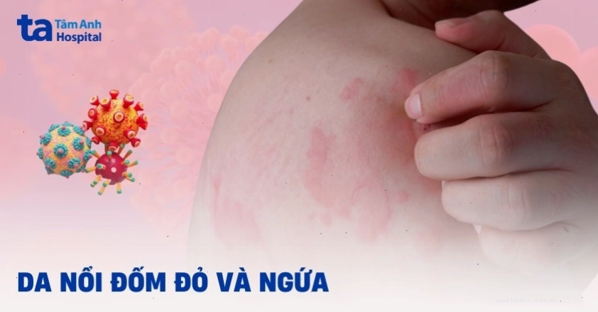 Nổi đốm đỏ trên da và ngứa là dấu hiệu cần lưu ý