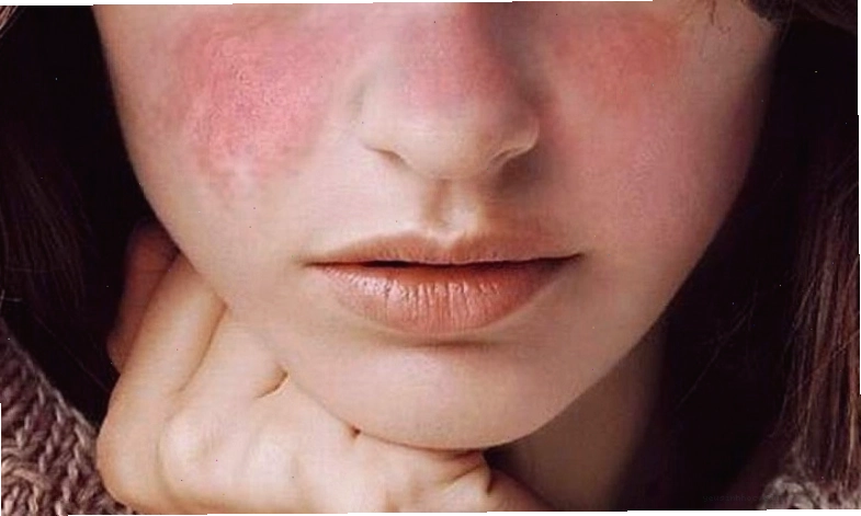 Nổi mẩn đỏ không ngứa là do bệnh lý nào, có nguy hiểm không?