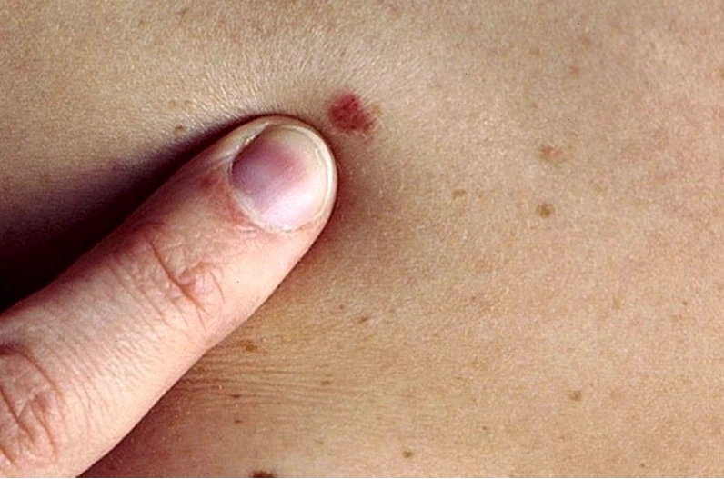 Nổi mẩn đỏ không ngứa là do bệnh lý nào, có nguy hiểm không?