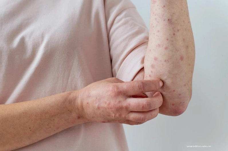 Nổi mẩn đỏ ngứa khắp người do dị ứng côn trùng hoặc các tác nhân môi trường
