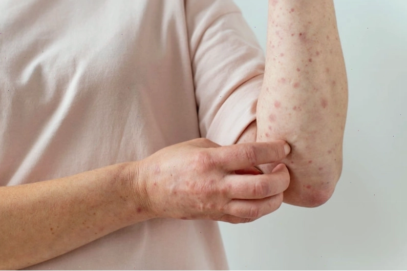 Nổi mẩn đỏ ngứa khắp người như muỗi đốt thường là do dị ứng