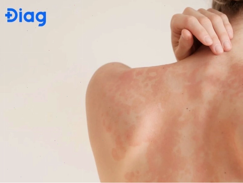 Nổi mẩn ngứa thành mảng trên da