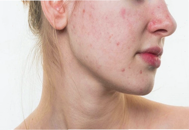 Nổi mụn nhiều là triệu chứng cảnh báo các vấn đề về gan