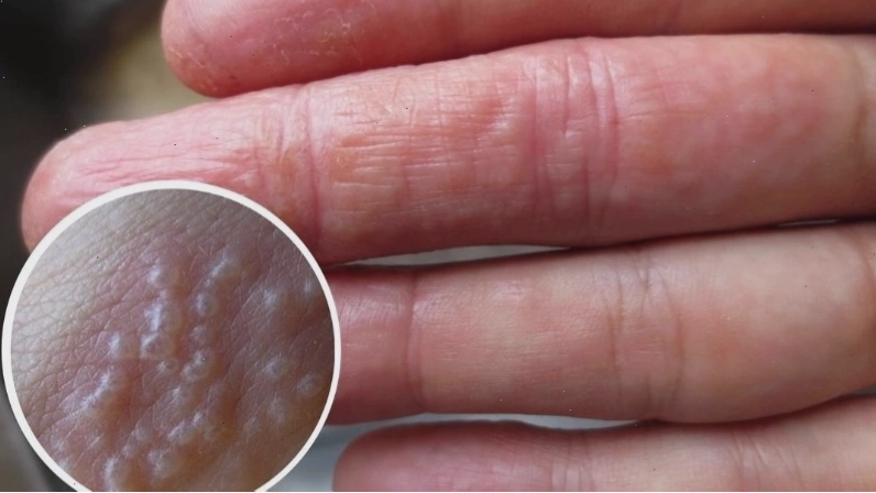 Nổi mụn nước là triệu chứng của phát ban đỏ