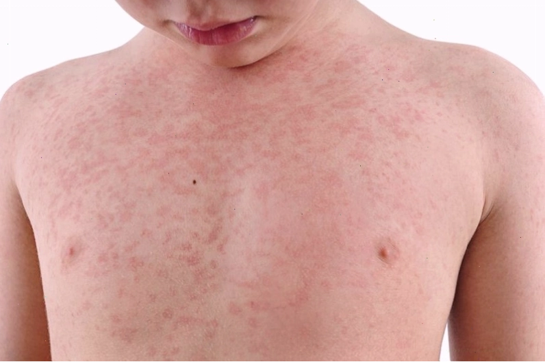 Nóng phát ban ở người lớn có thể nhầm lẫn với các bệnh ngoài da khác