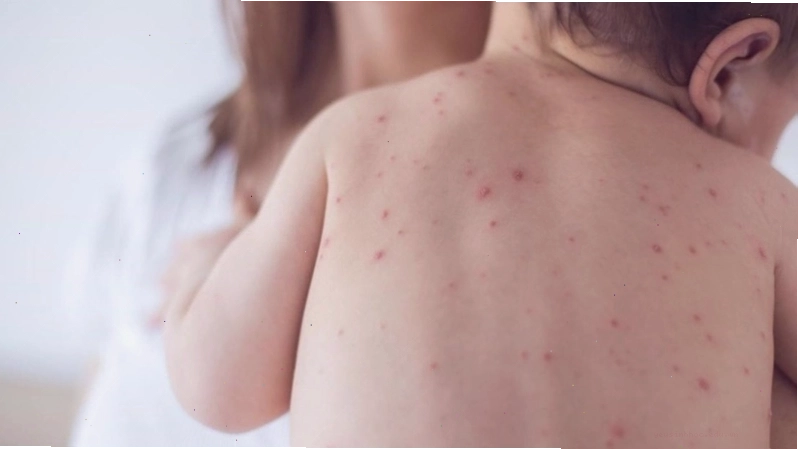 Nóng phát ban ở người lớn do thời tiết nóng ẩm gây tắc nghẽn tuyến mồ hôi
