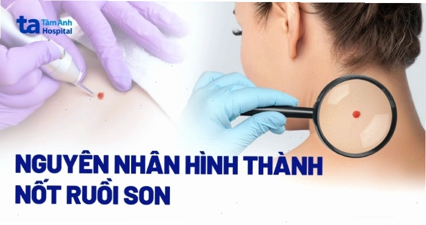 Nốt ruồi son là gì? Có hại không? Nguyên nhân hình thành