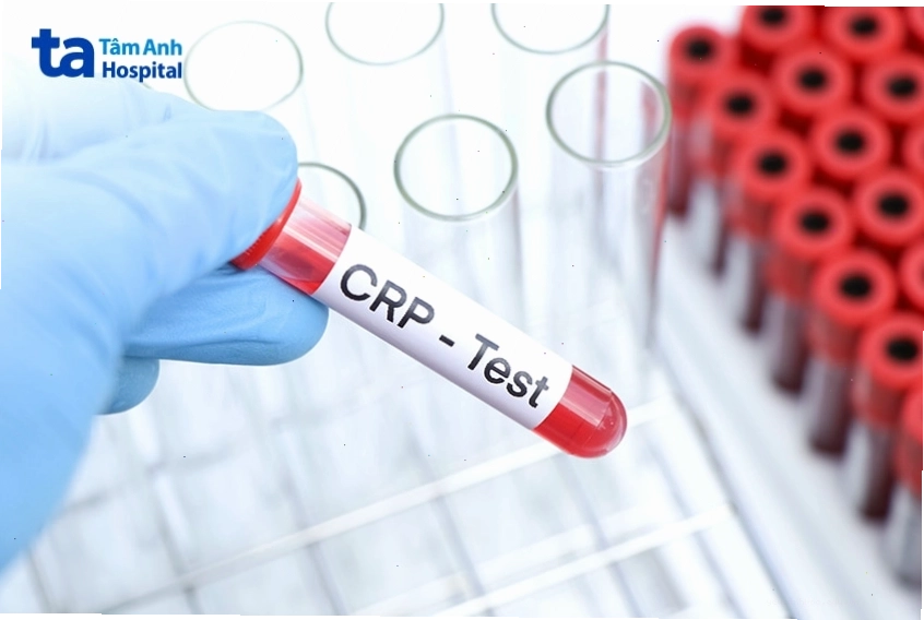 Ống nghiệm xét nghiệm CRP, một phần trong quy trình chẩn đoán viêm da hoặc phản ứng dị ứng