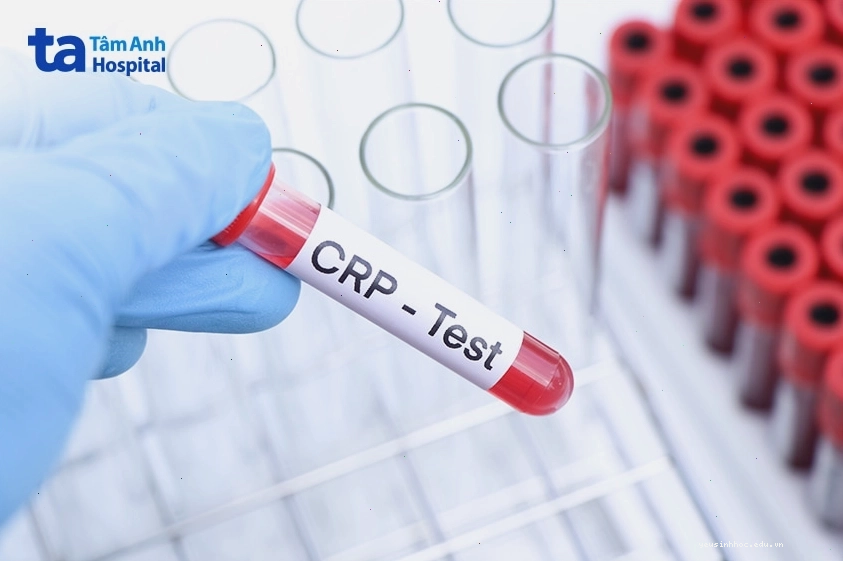 Ống nghiệm xét nghiệm CRP trong chẩn đoán viêm da