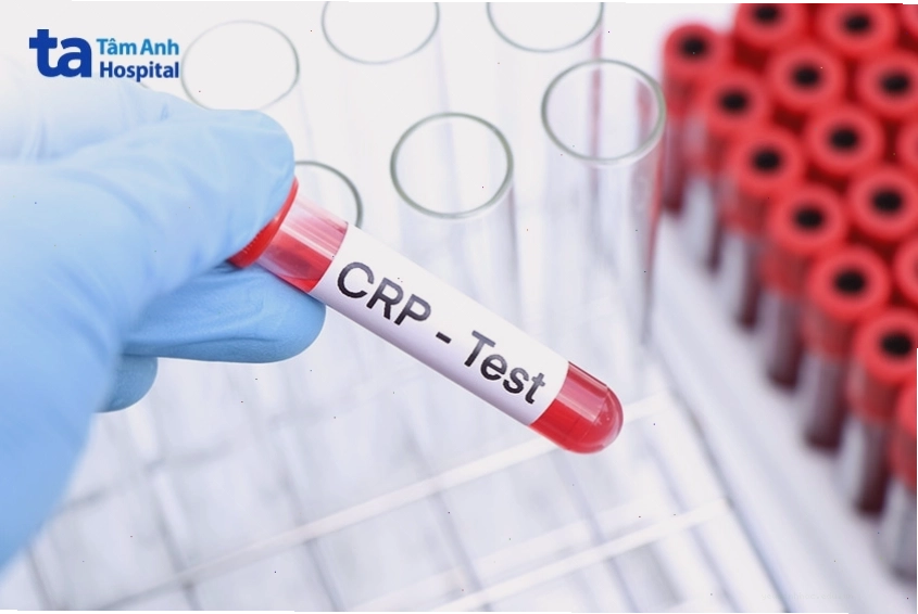 Ống nghiệm xét nghiệm CRP trong chẩn đoán viêm da hoặc phản ứng dị ứng