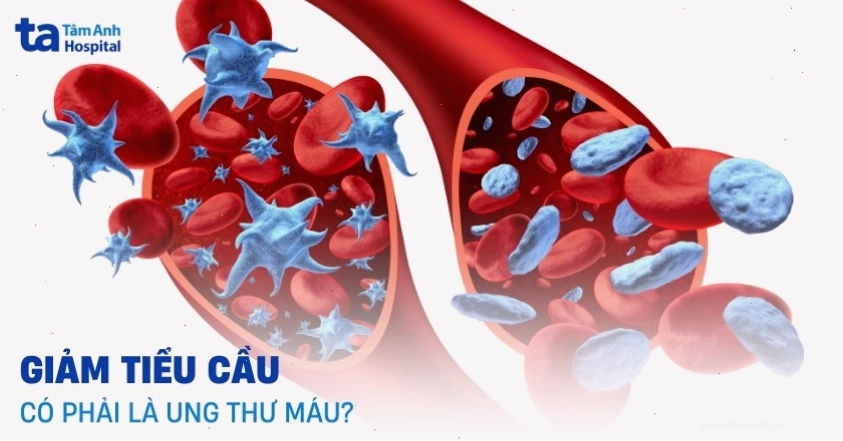 Phân biệt xuất huyết giảm tiểu cầu miễn dịch và ung thư máu