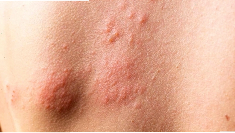 Phát ban ngoài da là một trong những biểu hiện ban đầu của người nhiễm HIV