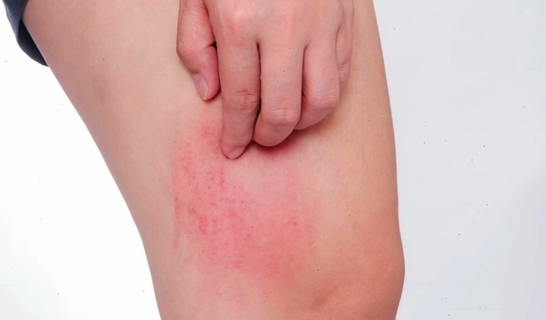 Phòng ngừa dị ứng bằng cách lựa chọn thực phẩm và môi trường sống phù hợp