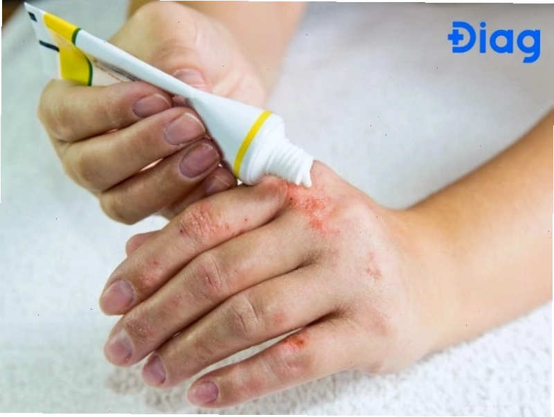 Phương pháp điều trị nổi mẩn ngứa