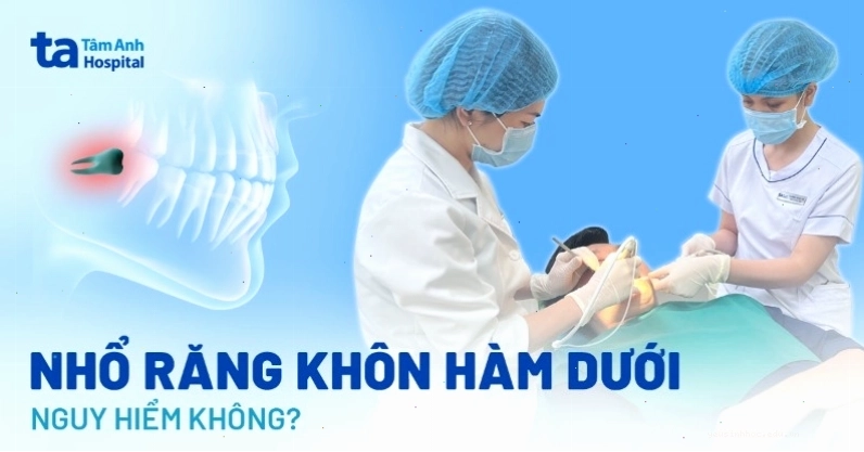 Răng khôn hàm dưới mọc lệch gây áp lực lên răng kế cận