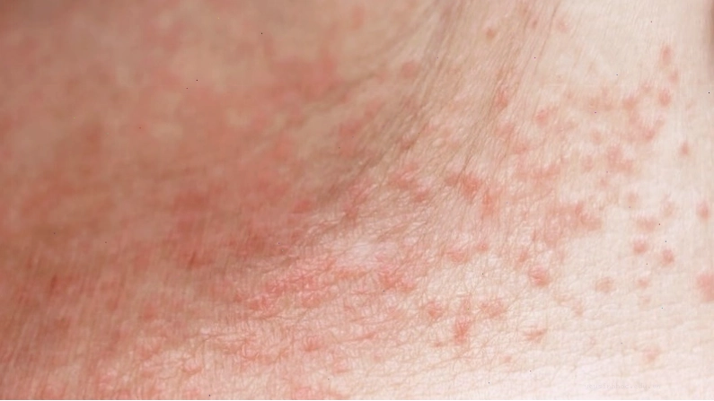 Rôm sảy đỏ xảy ra ở lớp trung bì của da