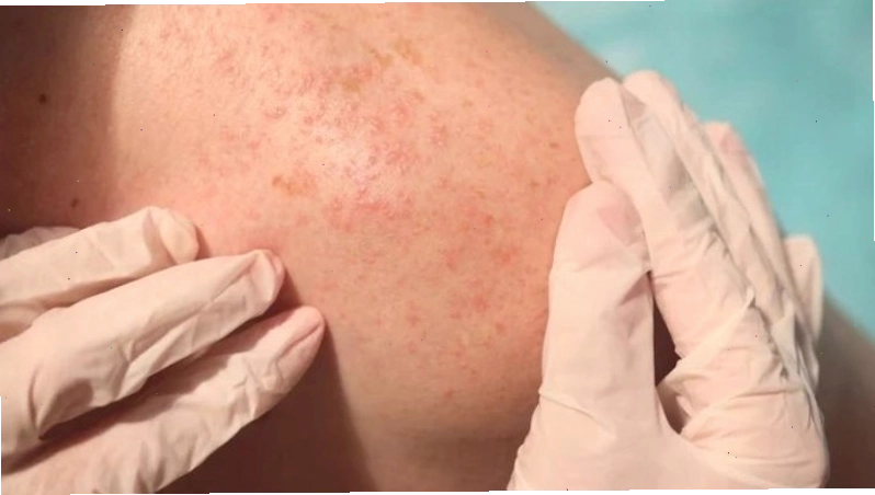 Rôm sảy hay phát ban do nhiệt là chứng bệnh ngoài da phổ biến